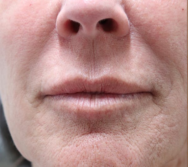 Lip Filler Before & After Gallery - Patient 144976766 - Image 2