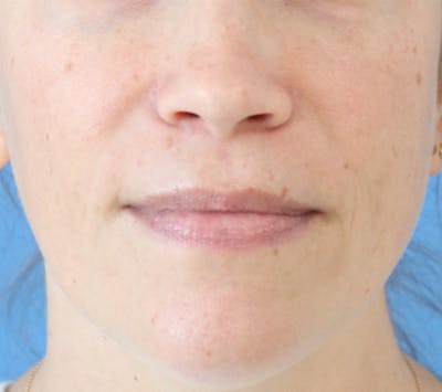 Lip Filler Before & After Gallery - Patient 148828610 - Image 1