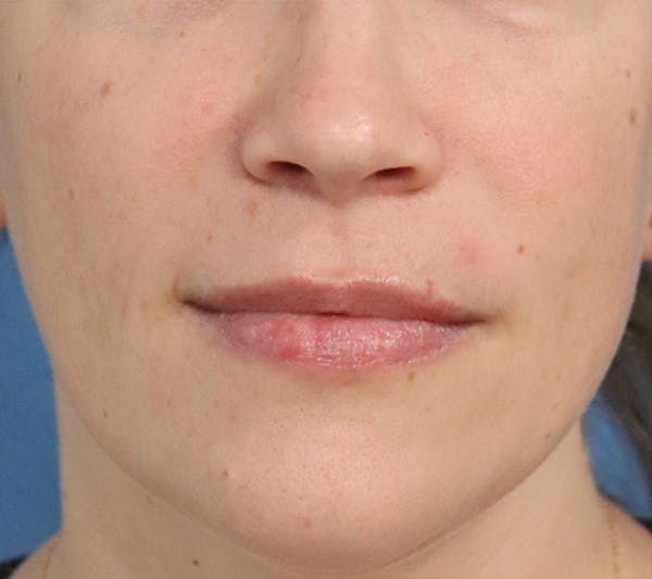 Lip Filler Before & After Gallery - Patient 148828610 - Image 2