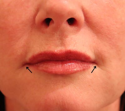 Lip Filler Before & After Gallery - Patient 144976905 - Image 1