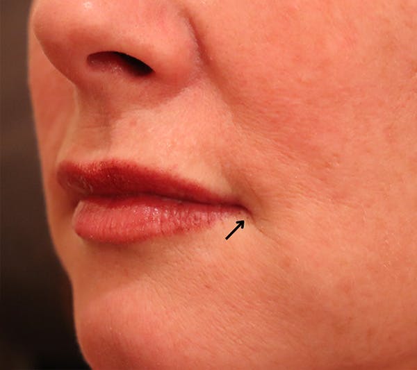 Lip Filler Before & After Gallery - Patient 144976905 - Image 3