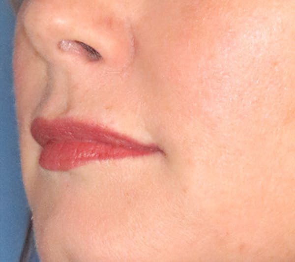 Lip Filler Before & After Gallery - Patient 144976905 - Image 4