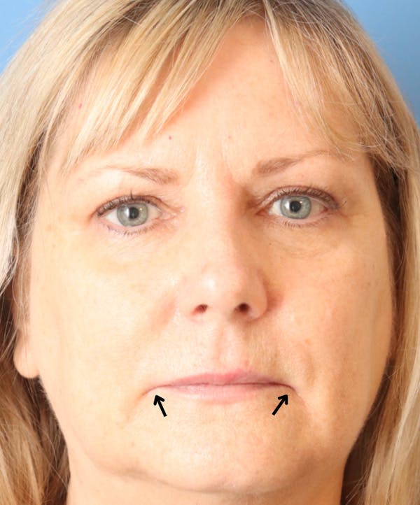 Lip Filler Before & After Gallery - Patient 144976918 - Image 1