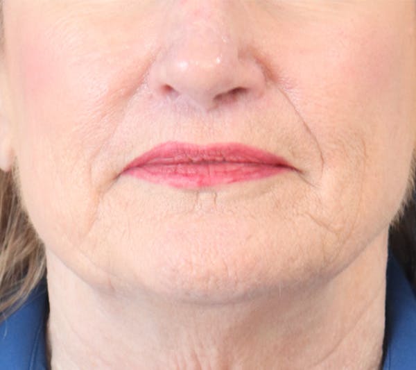 Lip Filler Before & After Gallery - Patient 148828611 - Image 5