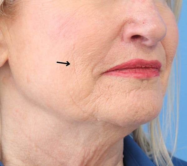 Lip Filler Before & After Gallery - Patient 148828611 - Image 3