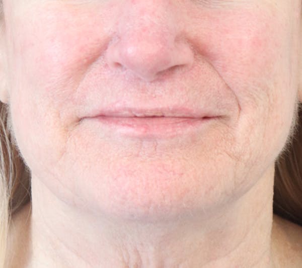 Lip Filler Before & After Gallery - Patient 148828611 - Image 6