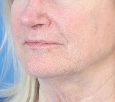 Lip Filler Before & After Gallery - Patient 148828611 - Image 2
