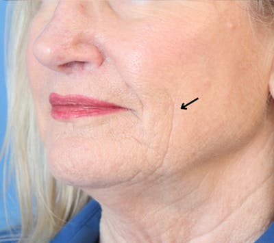 Lip Filler Before & After Gallery - Patient 148828611 - Image 1