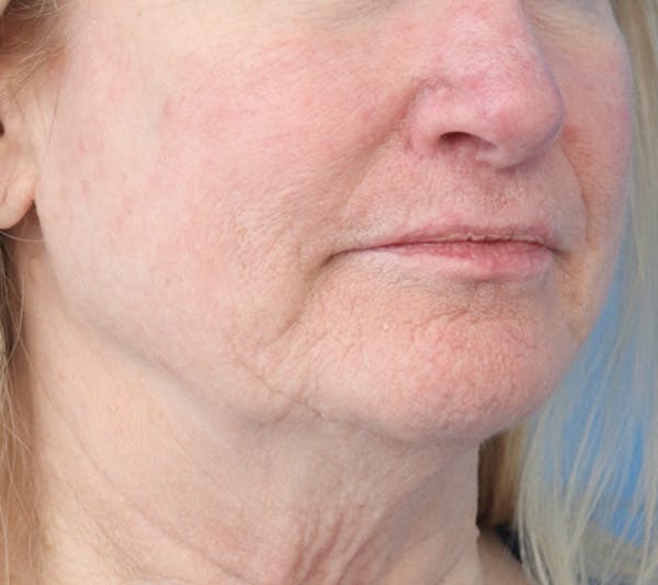 Lip Filler Before & After Gallery - Patient 148828611 - Image 4