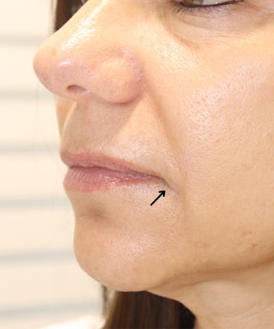 Lip Filler Before & After Gallery - Patient 145354904 - Image 1