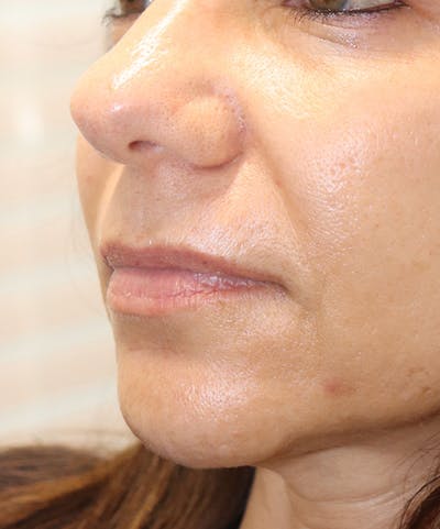Lip Filler Before & After Gallery - Patient 145354904 - Image 2