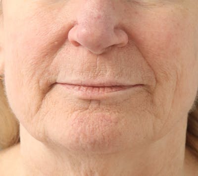 Lip Lift Before & After Gallery - Patient 148828613 - Image 1