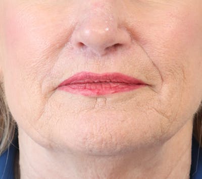 Lip Lift Before & After Gallery - Patient 148828613 - Image 2