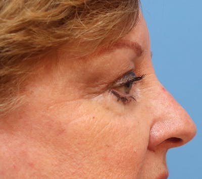 Mole Removal Before & After Gallery - Patient 32769518 - Image 2