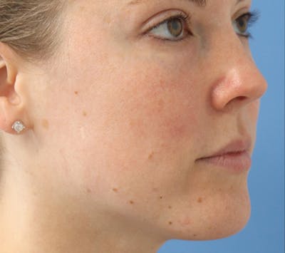 Mole Removal Before & After Gallery - Patient 145354857 - Image 2