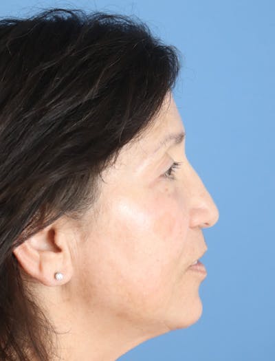 Rhinoplasty Before & After Gallery - Patient 148828619 - Image 1