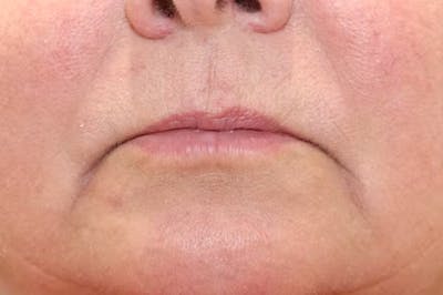 Lip Filler Before & After Gallery - Patient 149296908 - Image 1