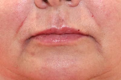 Lip Filler Before & After Gallery - Patient 149296908 - Image 2