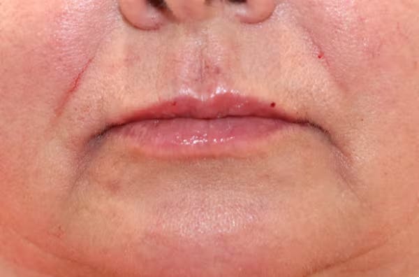 Lip Filler Before & After Gallery - Patient 149296908 - Image 2