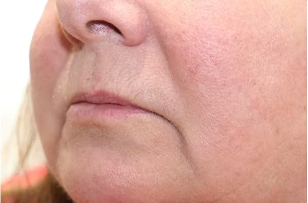 Lip Filler Before & After Gallery - Patient 149296908 - Image 3