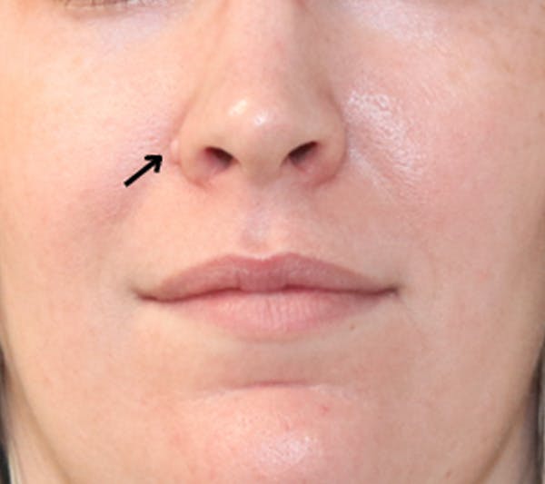 Mole Removal Before & After Gallery - Patient 123128089 - Image 3