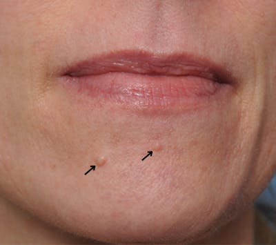 Mole Removal Before & After Gallery - Patient 8647154 - Image 1