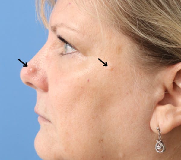 Mole Removal Before & After Gallery - Patient 145354855 - Image 1