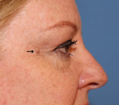 Mole Removal Before & After Gallery - Patient 32769518 - Image 1