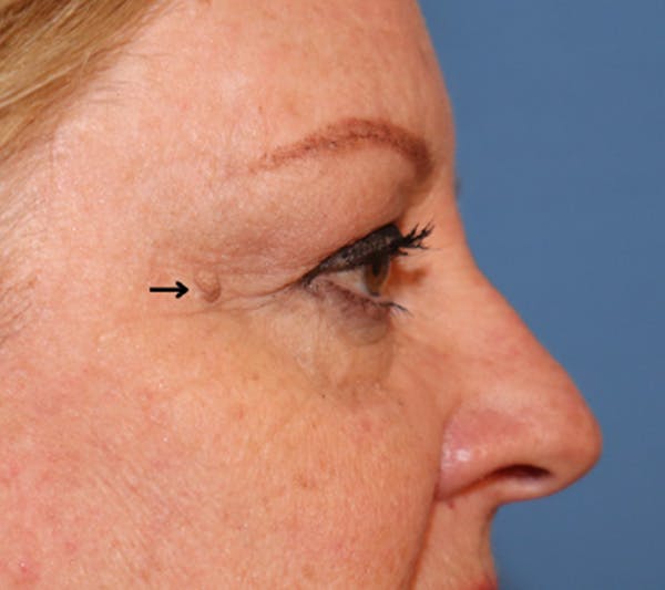 Mole Removal Before & After Gallery - Patient 32769518 - Image 1