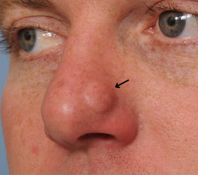 Mole Removal Before & After Gallery - Patient 8647153 - Image 1