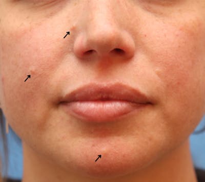 Mole Removal Before & After Gallery - Patient 122660409 - Image 1