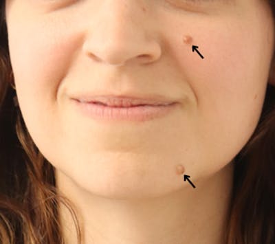 Mole Removal Before & After Gallery - Patient 148828616 - Image 1