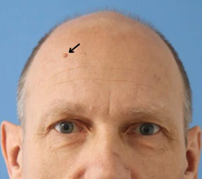 Mole Removal Before & After Gallery - Patient 149297292 - Image 1