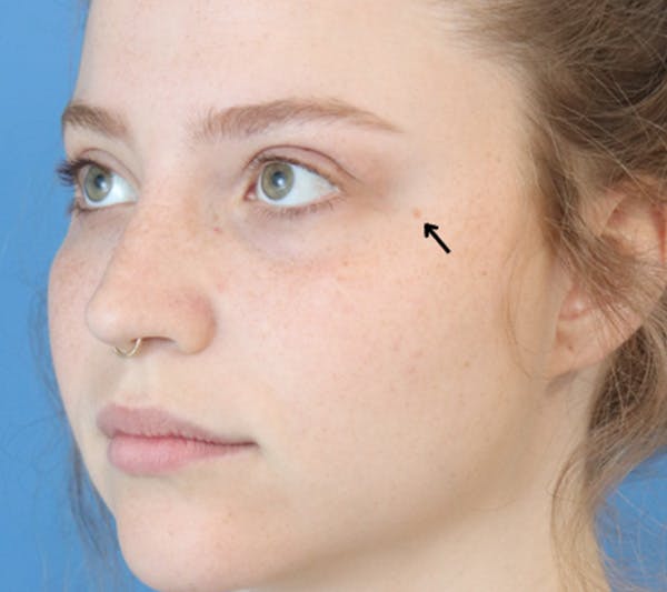 Mole Removal Before & After Gallery - Patient 149297293 - Image 1