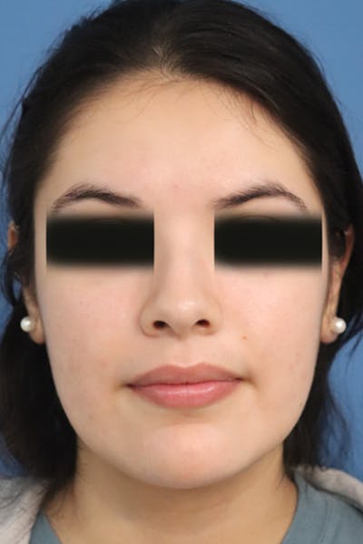 Buccal Fat Removal Before & After Gallery - Patient 152434126 - Image 2
