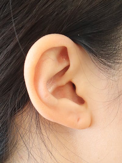 Earlobe Repair Before & After Gallery - Patient 152434076 - Image 1