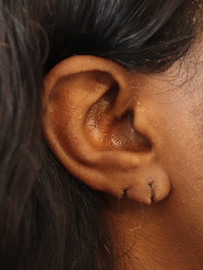 Earlobe Repair Before & After Gallery - Patient 152434075 - Image 1