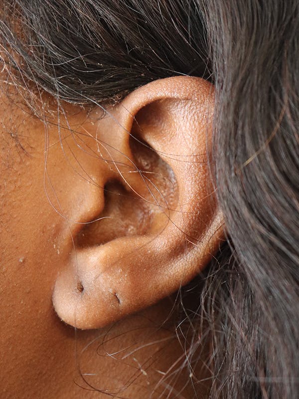 Earlobe Repair Before & After Gallery - Patient 152434075 - Image 3