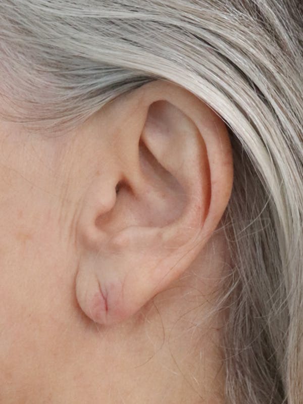 Earlobe Repair Before & After Gallery - Patient 152434077 - Image 1