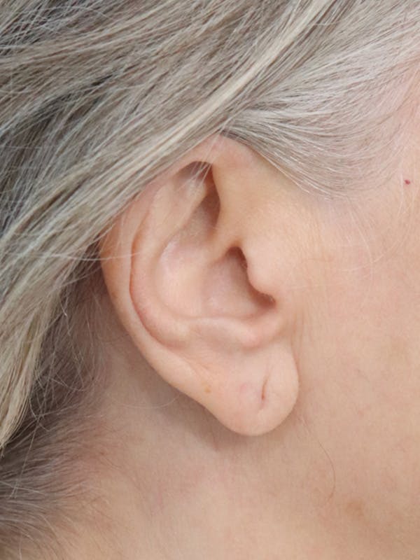 Earlobe Repair Before & After Gallery - Patient 152434077 - Image 3