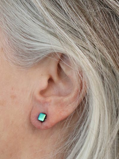 Earlobe Repair Before & After Gallery - Patient 152434077 - Image 2