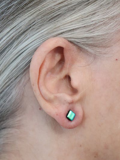 Earlobe Repair Before & After Gallery - Patient 152434077 - Image 4