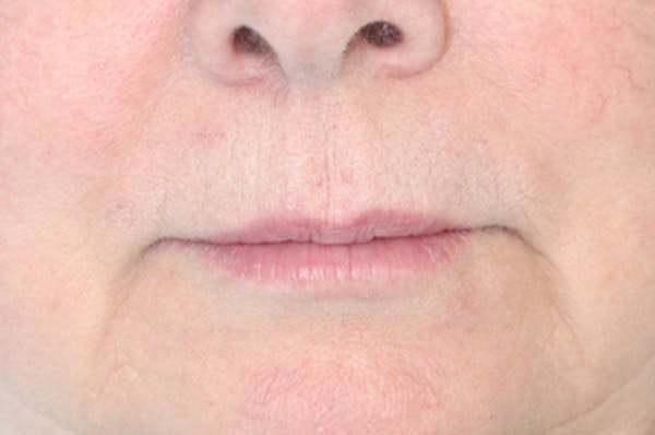 Lip Filler Before & After Gallery - Patient 152434082 - Image 1