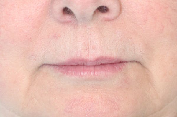 Lip Filler Before & After Gallery - Patient 152434082 - Image 1