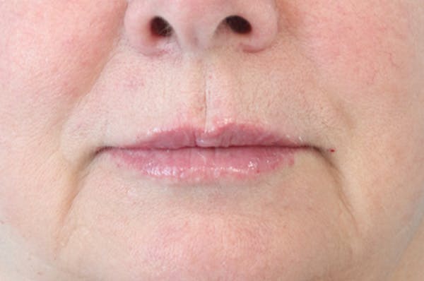 Lip Filler Before & After Gallery - Patient 152434082 - Image 2