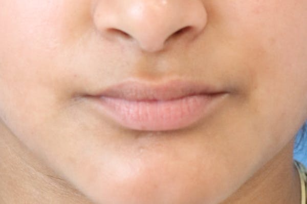 Lip Filler Before & After Gallery - Patient 152434080 - Image 1