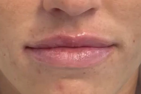 Lip Filler Before & After Gallery - Patient 152434081 - Image 2