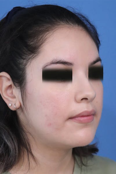 Liquid Rhinoplasty Before & After Gallery - Patient 152434122 - Image 1