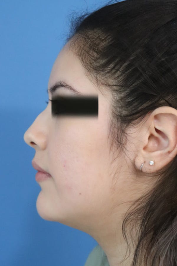 Liquid Rhinoplasty Before & After Gallery - Patient 152434122 - Image 3