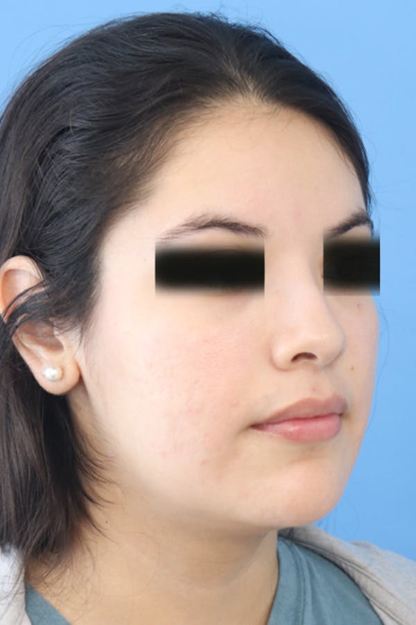 Liquid Rhinoplasty Before & After Gallery - Patient 152434122 - Image 2